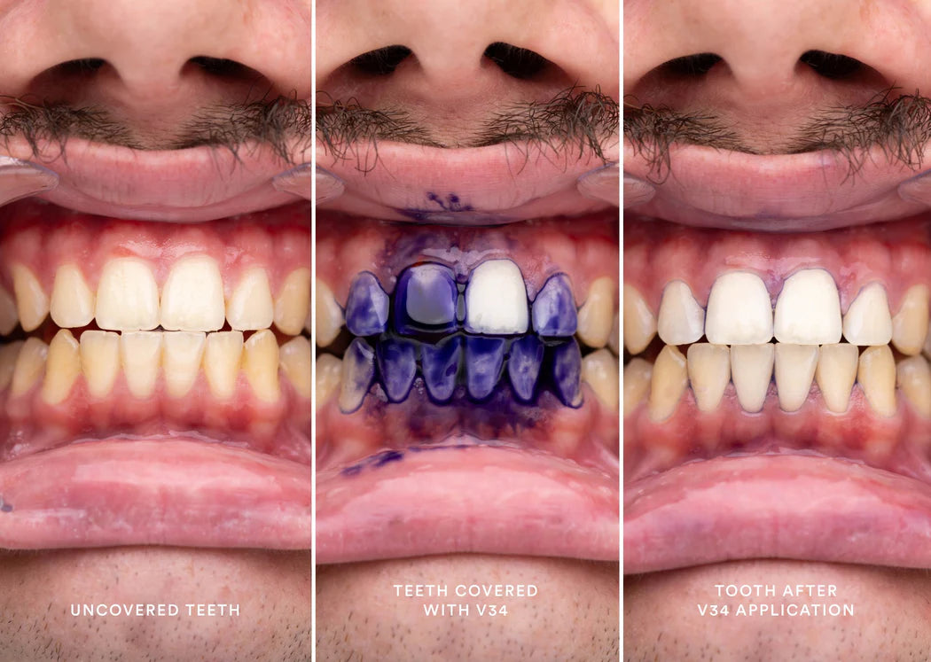 Blanqueador de Dientes Profesional - hismile🦷✨